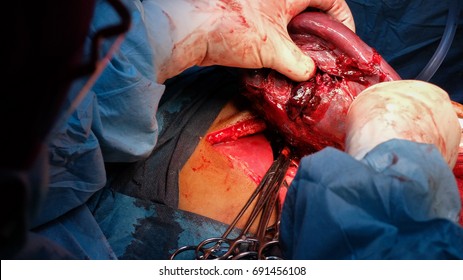 Ruptured Spleen Exposed During Surgery. Splenectomy Performed.