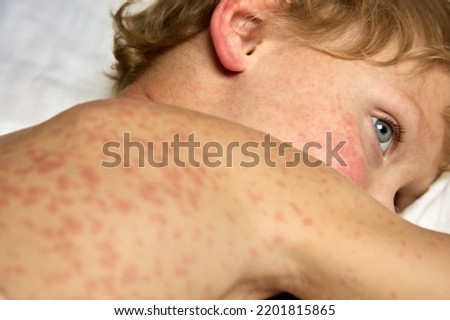 Sad little boy is sick with rubella, lies on a hospital bed covered with spots. Sad child covered with allergic red spots lies sick