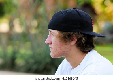 Sad teen boy outdoors with acne looking away from camera with black backwards hat and white shirt.