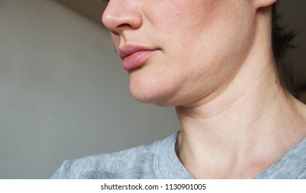 Sagging Chin. Face Line Correction