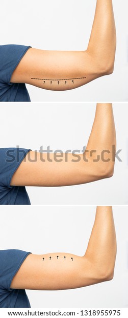 Saggy Skin Removal Arm Before After Stock Photo 1318955975 