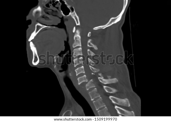 Sagittal Computer Tomography Or Ct Image Of Cervical Spine Showing C6 7 Bilateral Facet Joint