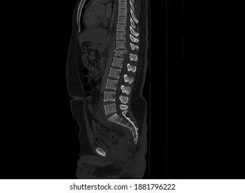 A Sagittal Image Computer Tomography Of Thoracolumbar Spine Showing Unstable Burst Fracture Of T12 Vertebra. The Fracture Cause Spinal Cord Injury And Cauda Equina Syndrome.