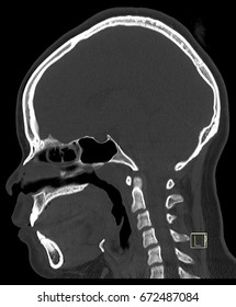 Sagittal Plane Of Skull In Bone Window. This Image Reconstruction From CT Scan.