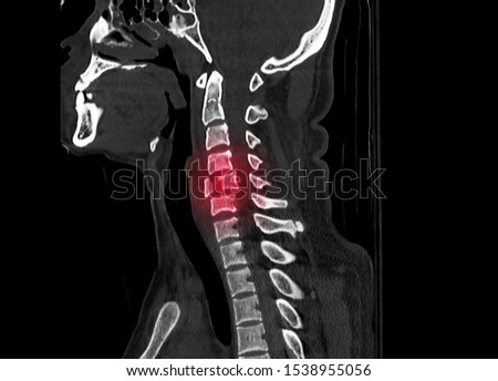 Sagittal view computer tomography or CT image of cervical spine showing burst fracture of C5 vertebra after an accident. The patient had neck pain, spinal cord injury and cauda equina syndrome.