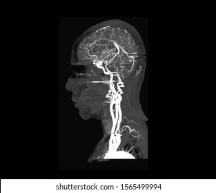 A sagittal view of magnetic resonance angiogram or MRA of the brain showing normal carotid artery. There is an aneurysm in the vessel in the brain that cause severe headache and paralysis.
