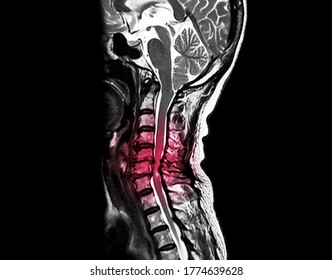 A Sagittal View Magnetic Resonance Image Or MRI Of Cervical Spine Showing Severe Spinal Cord Compression That Cause Neck Pain And Myelopathy. The Patient Needs Decompression And Spinal Fusion.