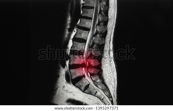 A\
sagittal view magnetic resonance image or MRI of lumbar spine\
showing ruptured intervertebral disc herniation at L4/5 level. The\
patient has back pain and sciatica or leg\
pain.
