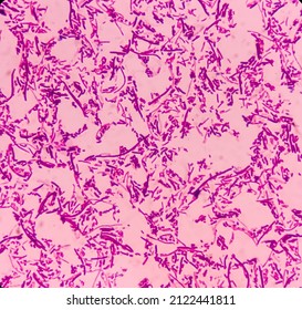 Salmonellosis: microscopic view of gram stained slide from blood agar salmonella colonies, show Salmonella Typhi (S. Typhi) bacteria, disease is referred to as typhoid fever.