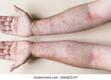 Sample Of Allergic Contact Dermatitis - Male Arms With Inflamed Skin