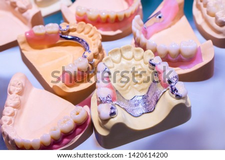 The sandwich denture. Removable denture. Orthopedic dental designs. Clasp dentures. Dentistry. Prosthetic dentistry.