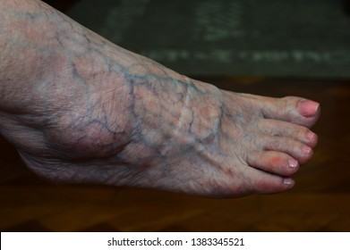 Sao Paulo / Brazil - April 28 2019: Closeup of a foot of an old lady with 
varicose veins in a household located in Sao Paulo, Brazil. 