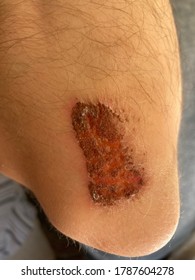 The Scab On Mans Elbow Becoming Better