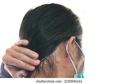 Scab Psoriasis Dermatitis Medical Mask Scars On The Skin. Psoriasis Is Caused By An Immune System Disorder Causing Psoriasis On The Skin. Psoriasis