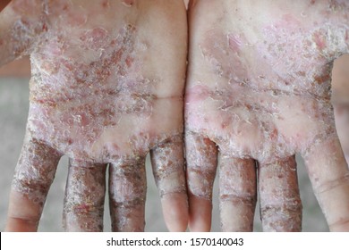 Scabies, Allergies And Dust Mites.Human Hand Dermatitis.