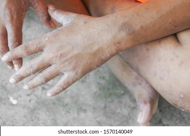 Scabies, Allergies And Dust Mites.Human Hand Dermatitis.