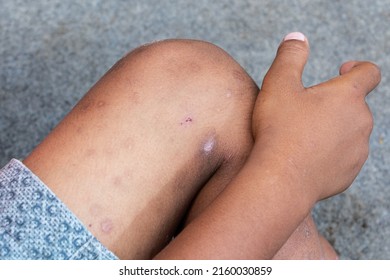 Scabies At The Feet Of A Small Child A Village In Indonesia