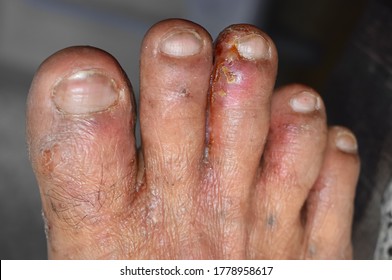 Scabies Infestation with secondary or fungal infection or tinea pedis in foot of Southeast Asian man.