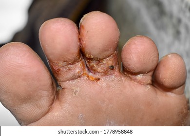 Scabies Infestation with secondary or fungal infection or tinea pedis in foot of Southeast Asian man.
 A contagious skin condition caused by mites.