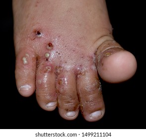 Scabies Infestation with secondary or superimposed bacterial infection in foot of Southeast Asian, Burmese Child. A contagious skin condition caused by mites. Isolated on black.