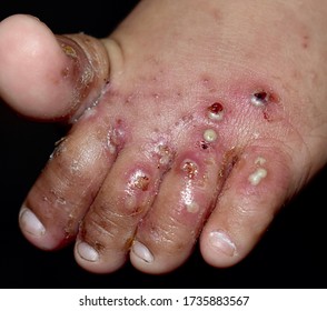 Scabies Infestation with secondary or superimposed bacterial infection and pustules in left foot of Southeast Asian, Burmese baby. A contagious skin condition caused by mites. Isolated on black.
