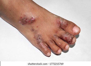 Scabies Infestation with secondary or superimposed bacterial infection and pustules in foot of Southeast Asian, Burmese baby. A contagious skin condition caused by mites. Isolated on white.