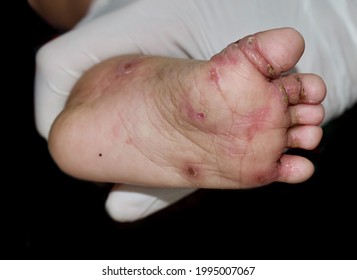 Scabies Infestation With Secondary Or Superimposed Bacterial Infection And Pustules In Foot Of Southeast Asian, Burmese Child. A Contagious Skin Condition Caused By Mites. Isolated On Black.