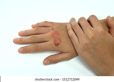 Scald Burn Images, Stock Photos & Vectors | Shutterstock