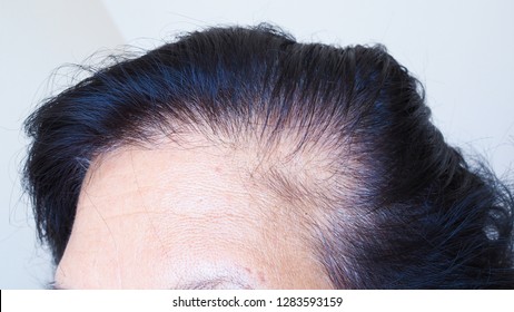 Scalp Problems Hair Loss White Hair Stock Photo 1283593159 | Shutterstock