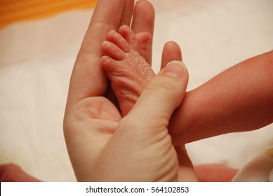 Scaly Skin On The Leg Of The Newborn Baby