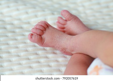 Scaly Skin On Newborn Baby Feet.