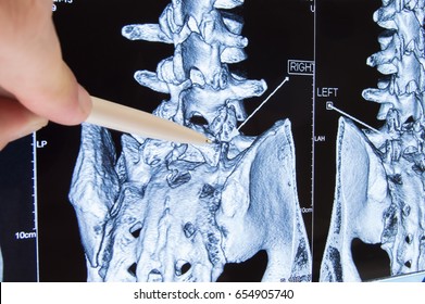 Scan Of Lumbosacral Spine. Doctor Pointed On Area Of Lumbar, Where Pathology Is Detected, Such As Radiculitis, Radiculopathy, Hernia, Low Back Pain. Diagnosis Of Spine Diseases By Radiology