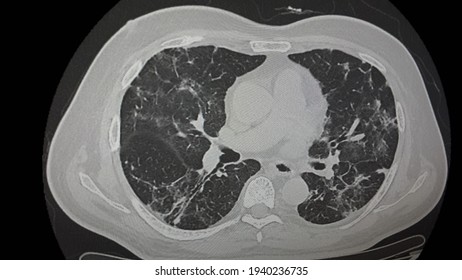 Scan Thorax In Covid Patien Lung Window