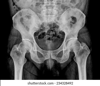 Scanning of an anterior posterior radiograph of the pelvis taken, among others radiographs, to try to detect the origin of pain in the hip of an adult man