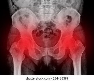 Scanning Of An Anterior Posterior Radiograph Of The Pelvis Taken, Among Others Radiographs, To Try To Detect The Origin Of Pain In The Hip Of An Adult Man