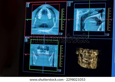 scanning of teeth on an X-ray image of a patient's jaw on a computer screen scaling of dentition dental clinic