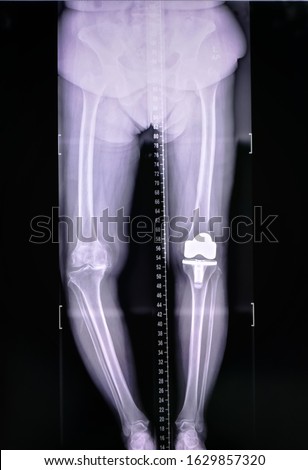 scanogram of lower limb or X-ray image of total lower extremity . Medical background concept.
