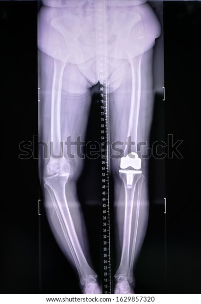 Scanogram Lower Limb Xray Image Total Foto De Stock Shutterstock