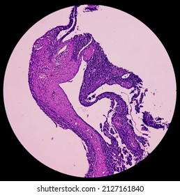 Scapula Cancer: Synovial Sarcoma, Monophasic, Show Malignant Neoplasm, Atypical Spindle Shaped Cells, Atypical Mitosis Present, Bone Cancer.