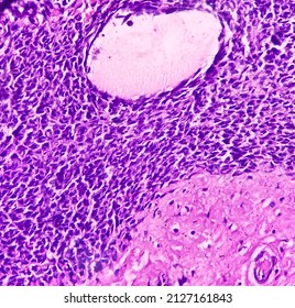 Scapula Cancer: Synovial Sarcoma, Monophasic, Show Malignant Neoplasm, Atypical Spindle Shaped Cells, Atypical Mitosis Present, Bone Cancer.