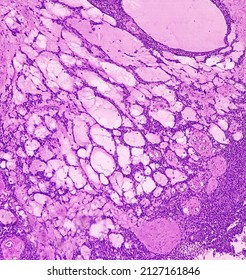 Scapula Cancer: Synovial Sarcoma, Monophasic, Show Malignant Neoplasm, Atypical Spindle Shaped Cells, Atypical Mitosis Present, Bone Cancer.