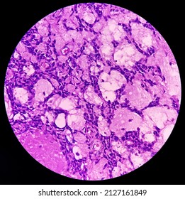 Scapula Cancer: Synovial Sarcoma, Monophasic, Show Malignant Neoplasm, Atypical Spindle Shaped Cells, Atypical Mitosis Present, Bone Cancer.