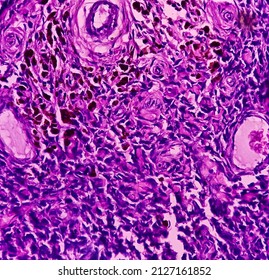 Scapula Cancer: Synovial Sarcoma, Monophasic, Show Malignant Neoplasm, Atypical Spindle Shaped Cells, Atypical Mitosis Present, Bone Cancer.