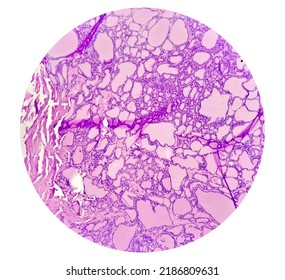 Scapula Cancer: Synovial Sarcoma, Monophasic, Show Malignant Neoplasm, Atypical Spindle Shaped Cells, Atypical Mitosis Present, Bone Cancer.