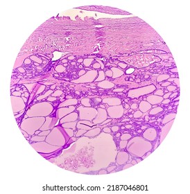 Scapula Cancer: Synovial Sarcoma, Monophasic, Show Malignant Neoplasm, Atypical Spindle Shaped Cells, Atypical Mitosis Present, Bone Cancer.