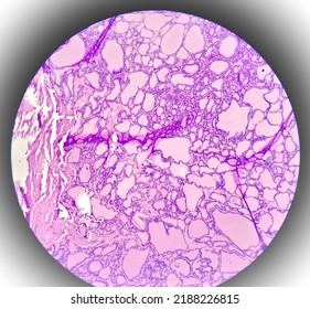 Scapula Cancer: Synovial Sarcoma, Monophasic, Show Malignant Neoplasm, Atypical Spindle Shaped Cells, Atypical Mitosis Present, Bone Cancer.