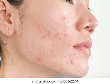 Scar from Acne on face .  and dark spots and skin problems and make-up in women