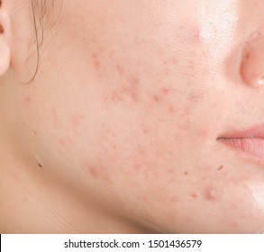 Scar From Acne On Face.  Dark Spots And Skin Problems  Make-up In Women