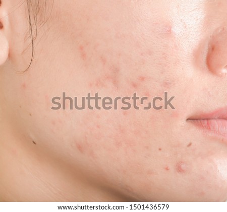 Scar from Acne on face.  Dark spots and skin problems  make-up in women
