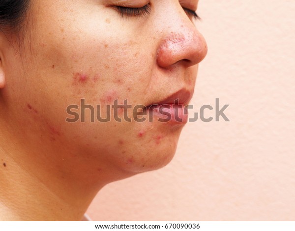 Akne Im Gesicht Gesichtssaule Melasma Haut Hautprobleme Stockfoto Jetzt Bearbeiten